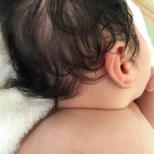 赤ちゃんのあせも 首や耳後ろの赤いブツブツ対策に保湿 ダイパークリーム Coco Mama Blog